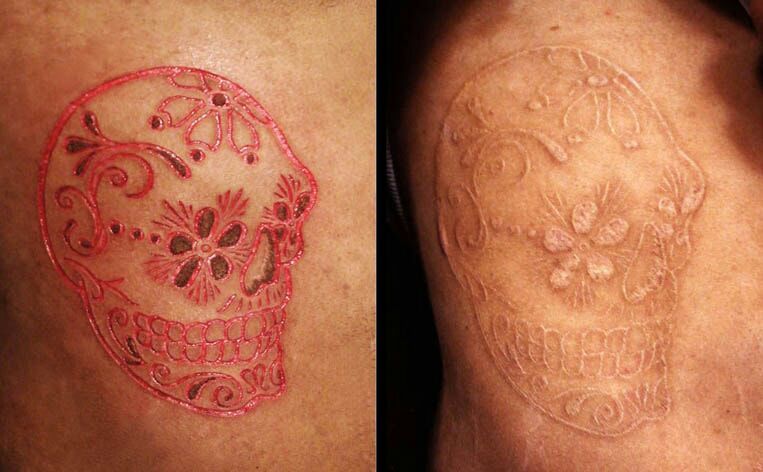 Escarificación: los tatuajes cicatrices 17